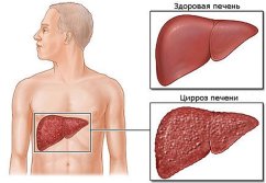 Новости про - Эластометрия печени, что это такое, её нормальные показатели и подготовка к процедуре
