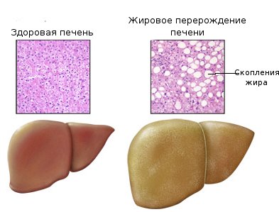 Новости про - Симптомы диффузии паренхимы и что с этим делать
